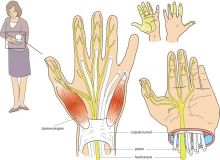 Carpaal tunnel syndroom